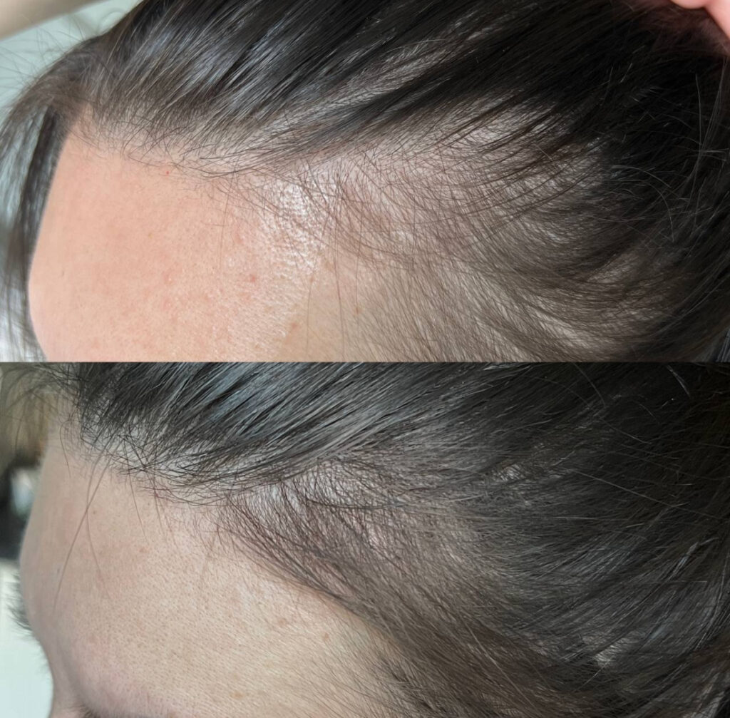 Scalp Mesotherapy