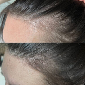 Scalp Mesotherapy