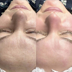 Face Mesotheraphy