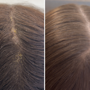 Scalp Exfoliation